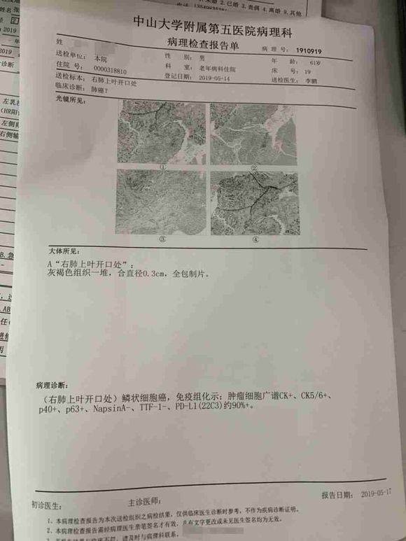 求救，肺鳞癌晚期脑转移，医生建议化疗加免疫。