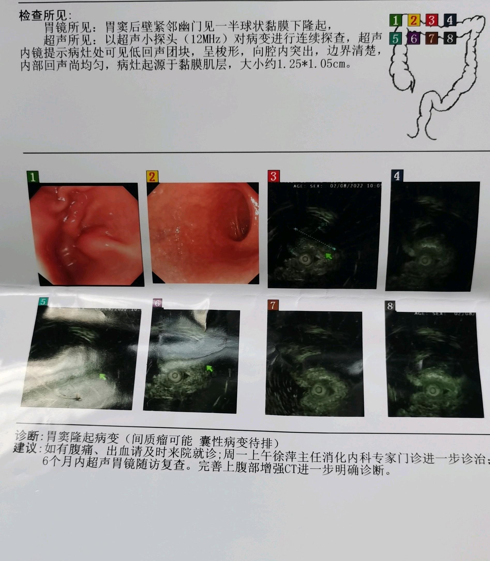 求科普胃间质瘤