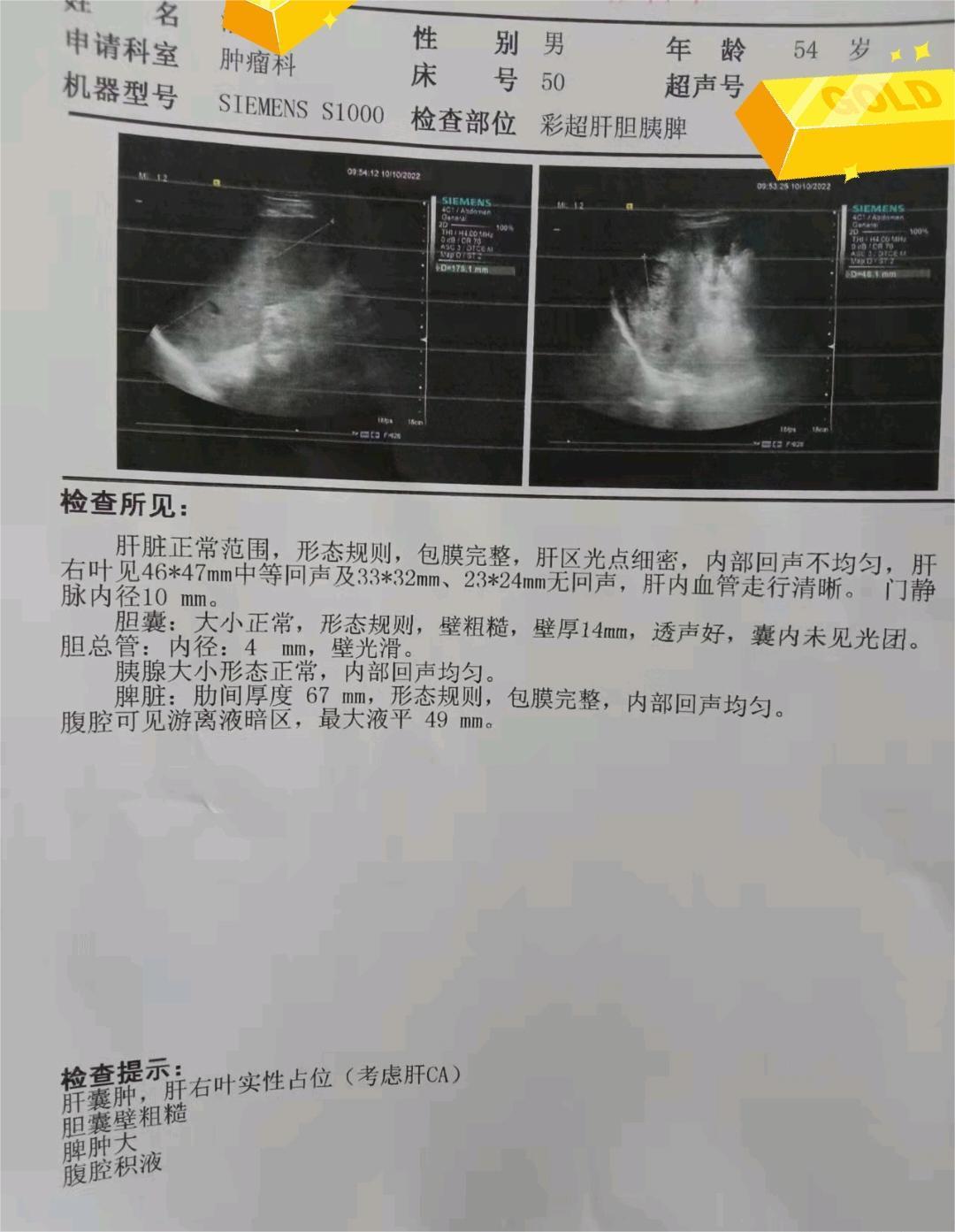 老爸确诊肝癌