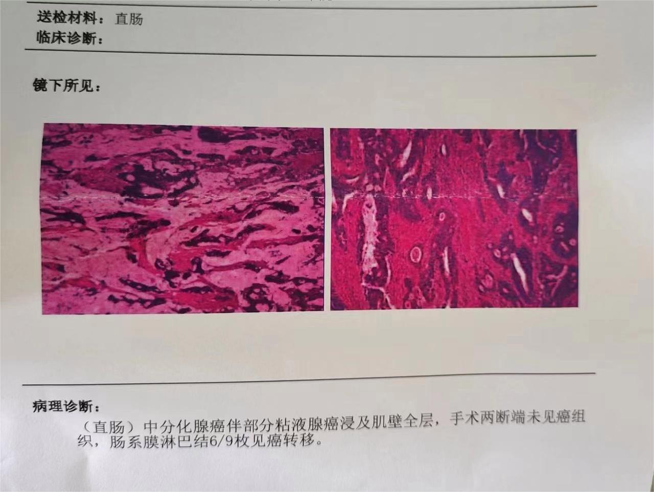 肠系膜淋巴结6/9枚见癌转移是什么意思啊