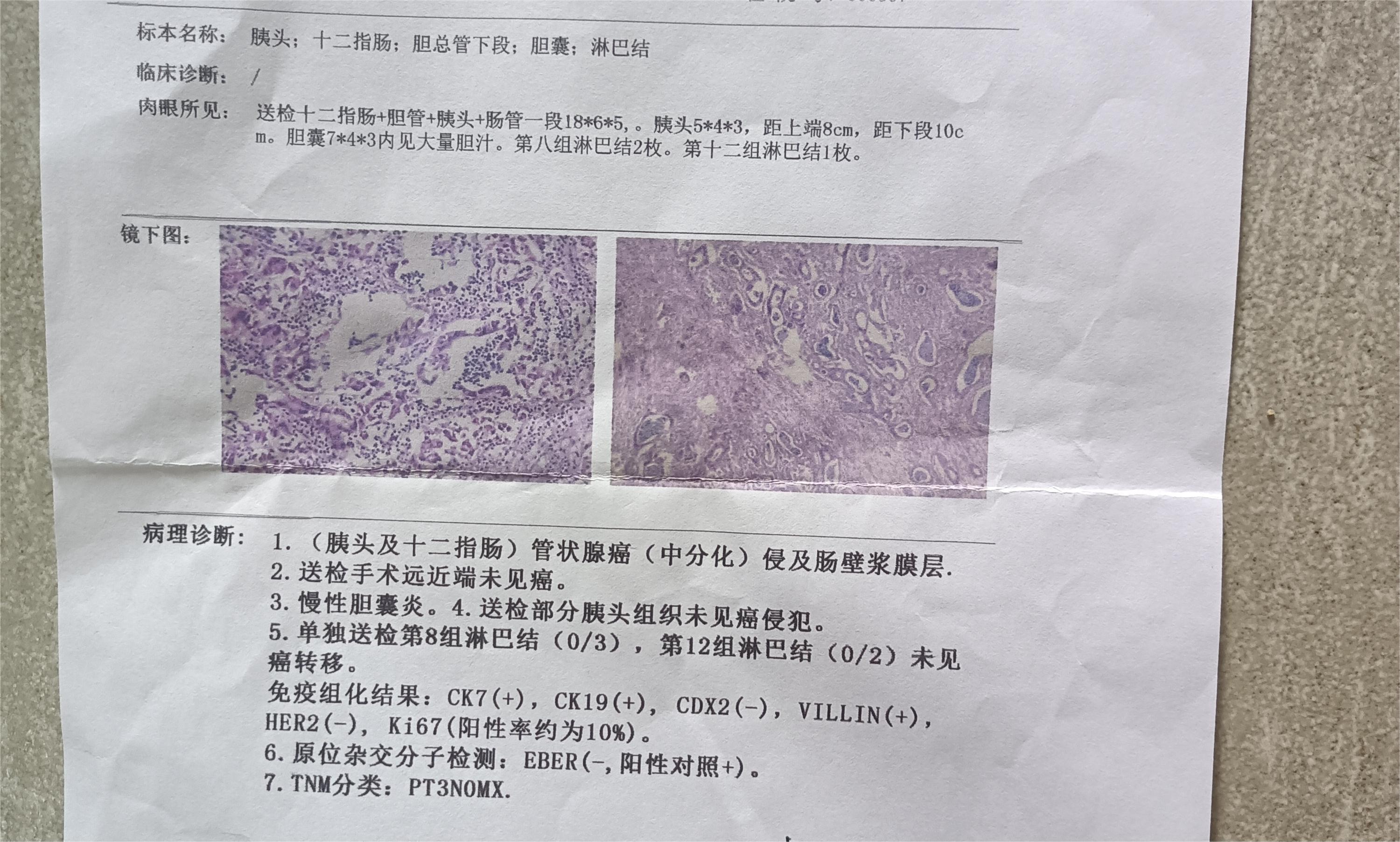 今天病理报告出来了，医生说后期要治疗方案是化疗