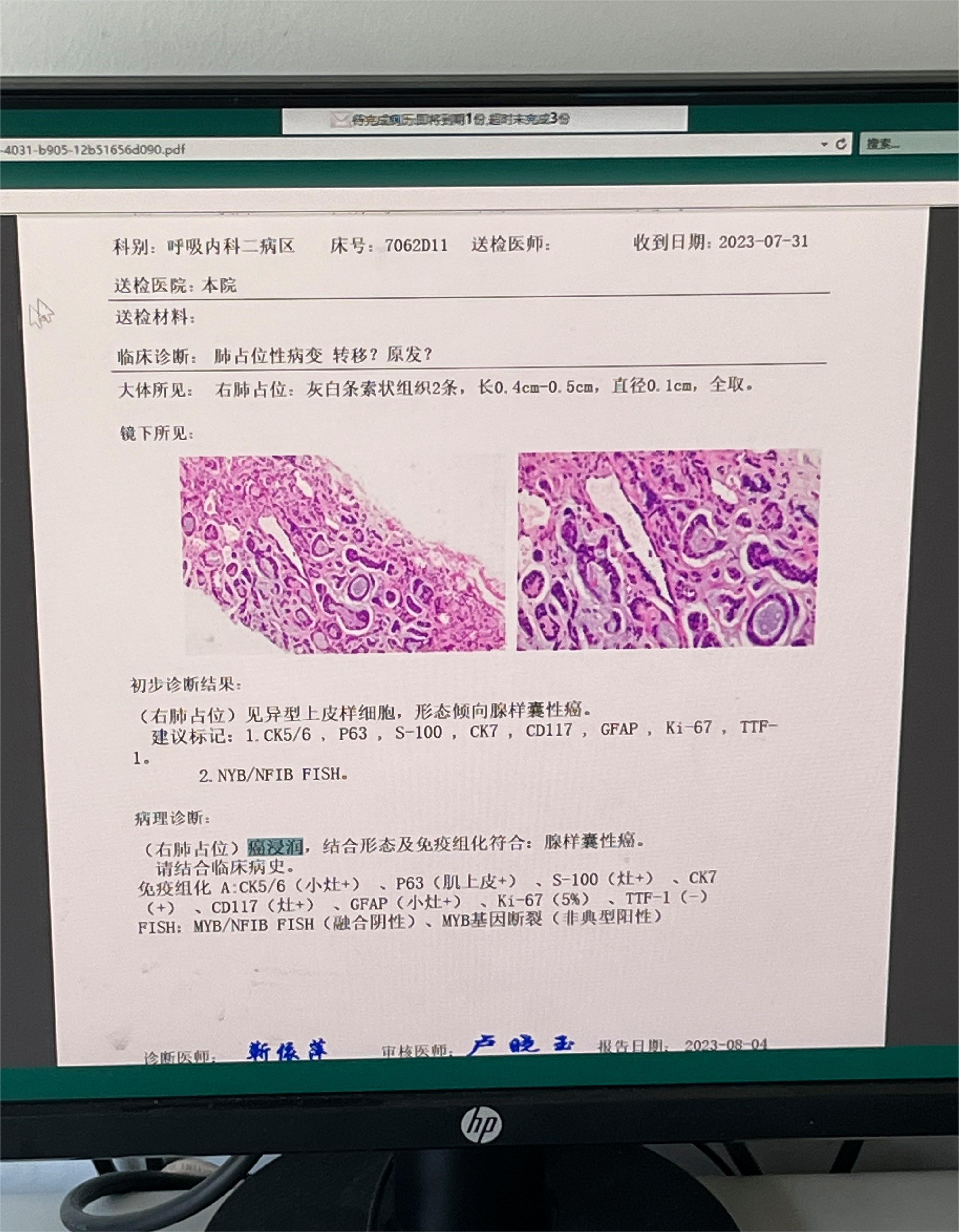 求助，8年前腺样囊性癌术后至今，右肺上叶突发1cm结节