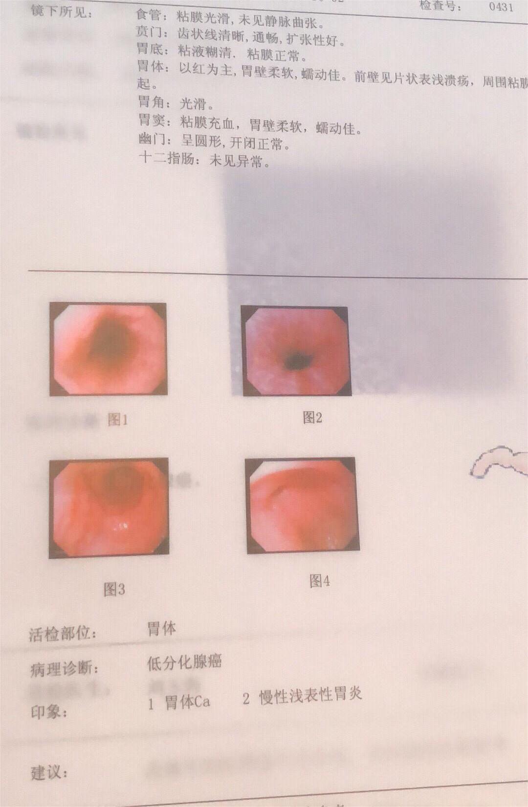 很可怕的低分化胃癌