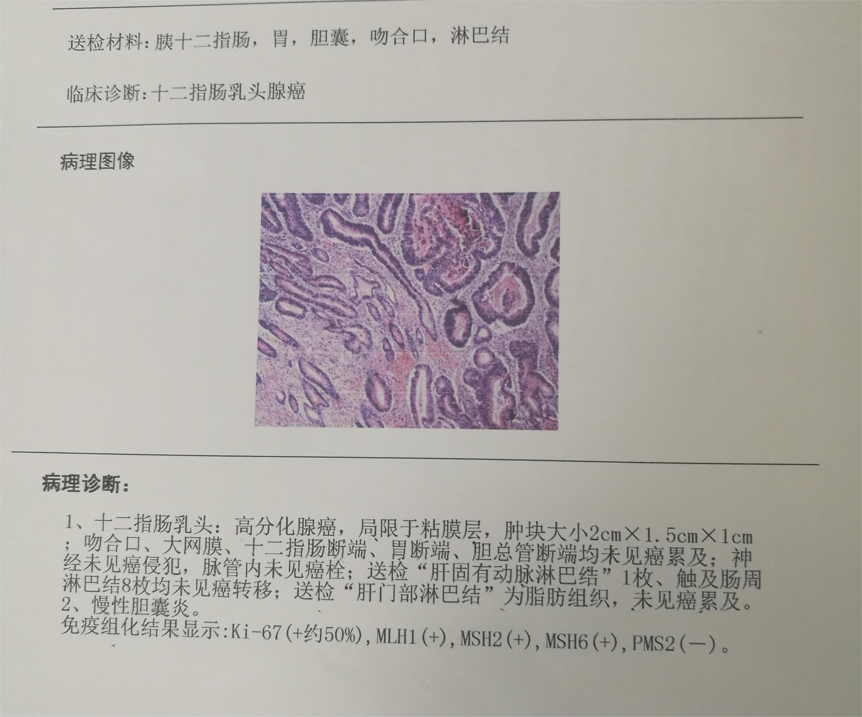 关于十二指肠乳头腺癌希望有人能够解答一下